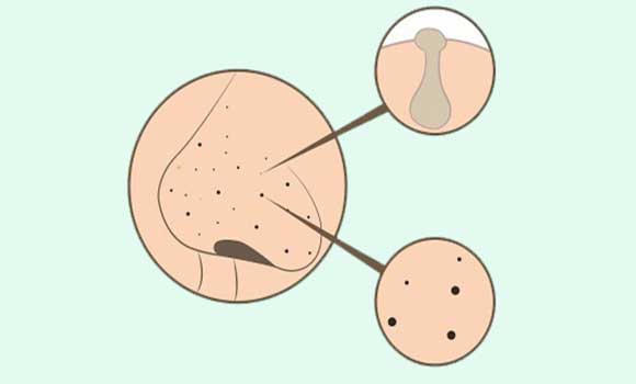 How are blackheads formed