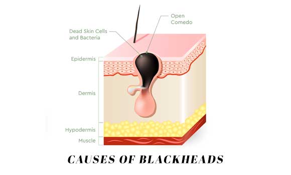 causes of blackheads