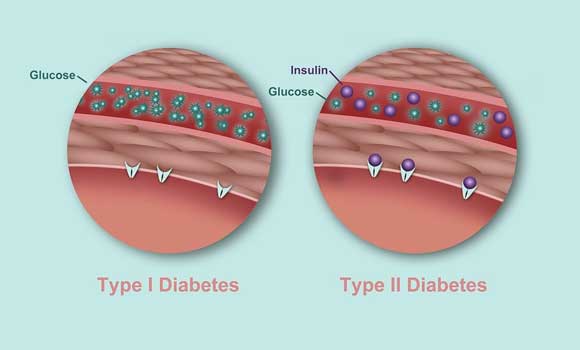 common types of diabetes