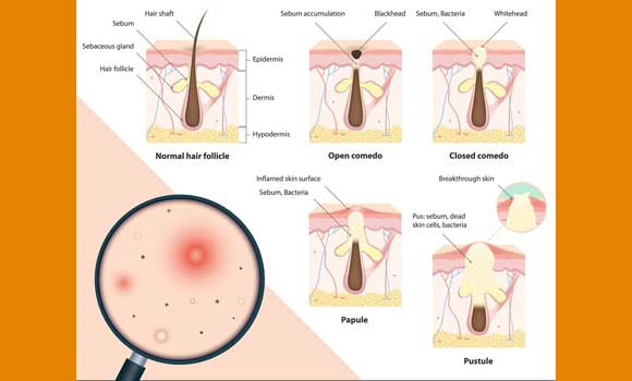 factors are responsible for causing blackheads