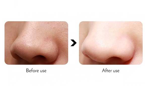 ways of removing blackheads