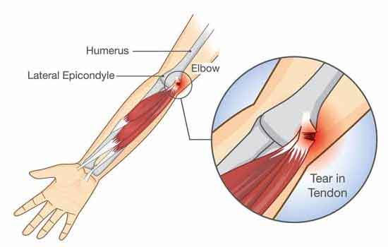 Elbow injury 
